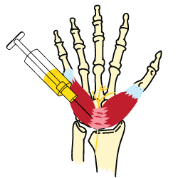 Carpal Tunnel Syndrome