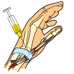 De Quervain's Syndrome