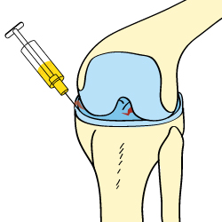 Knee Injury Treatment