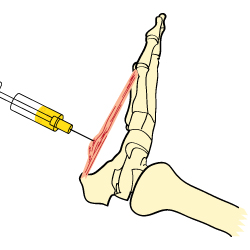 Plantar Fasciitis