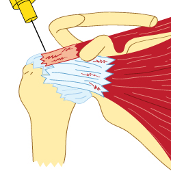 Rotator Cuff