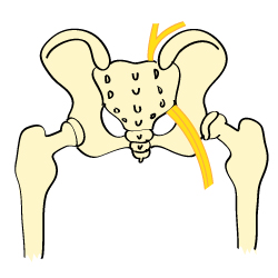 Sciatica (Low Back Pain)