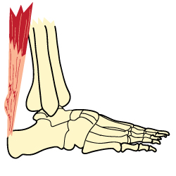 Achilles Tendonitis