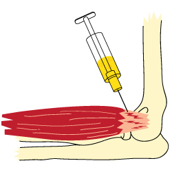 What is tennis elbow?