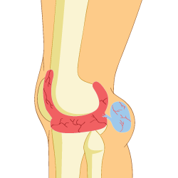 Baker's Cyst